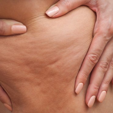 Cellulite cellulites