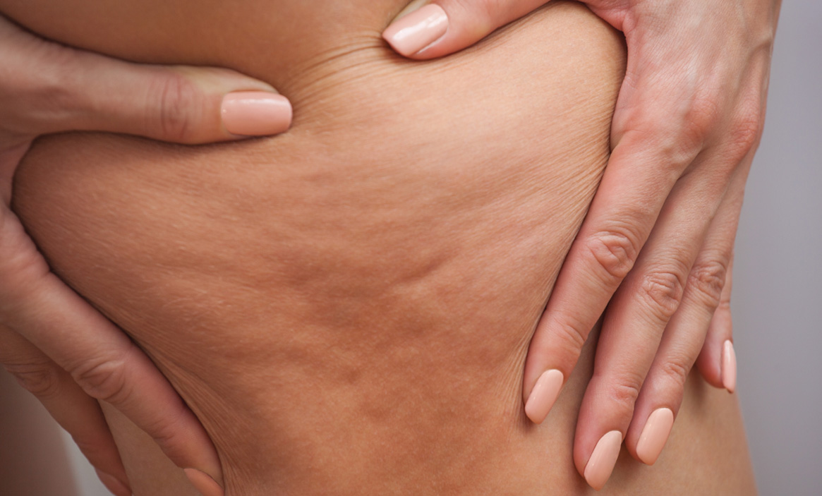 Cellulite