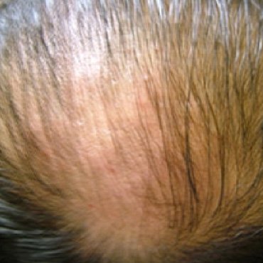 Hair-loss loss of hair