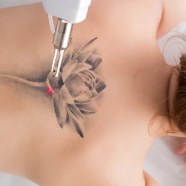 Unwanted-Vein tattoo removal