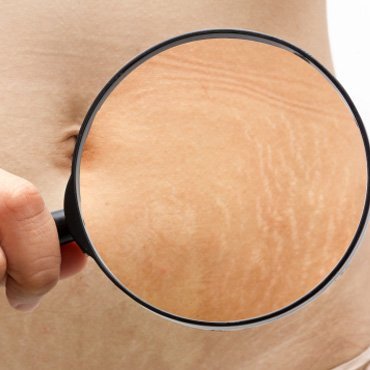 Stretchmarks stretchmarks