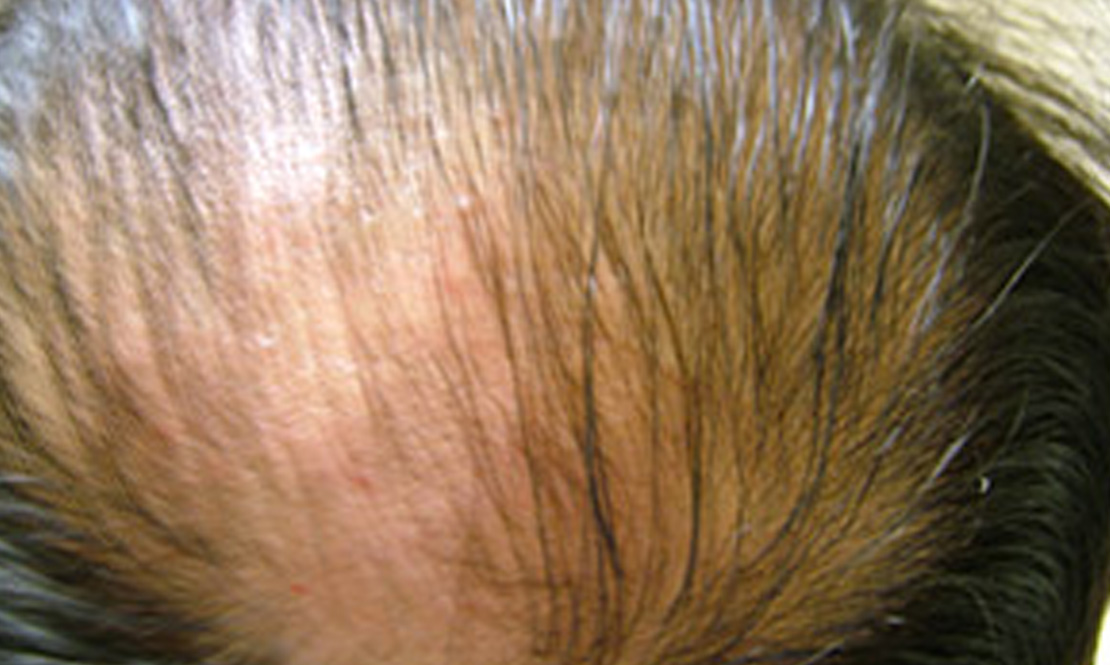 Hair Loss