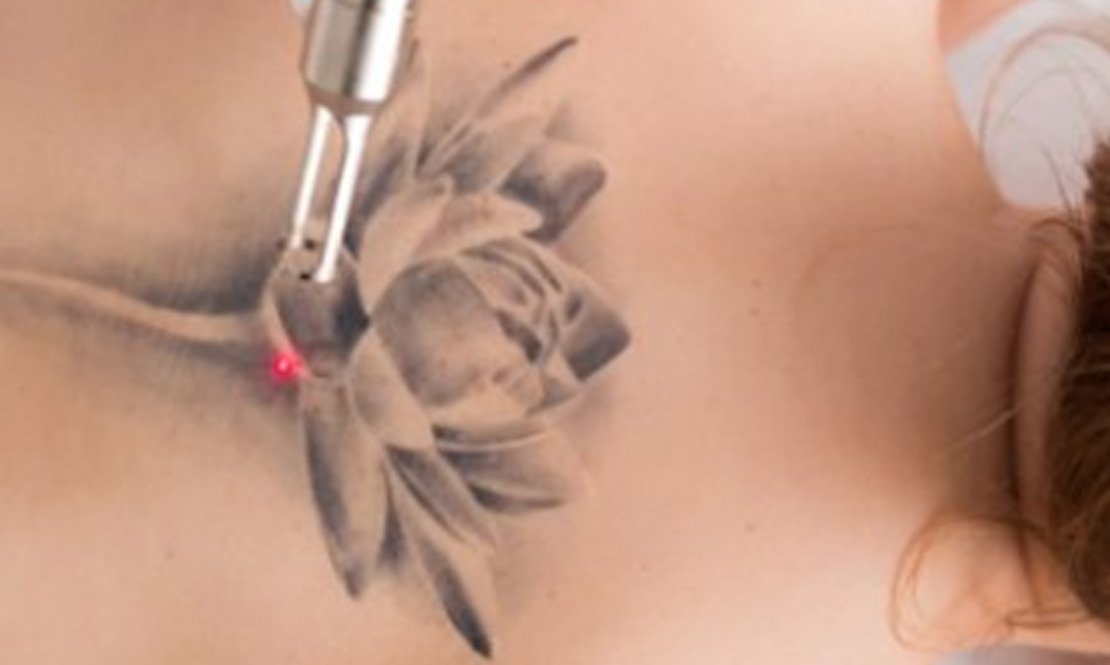 Unwanted Vein/ Tattoo