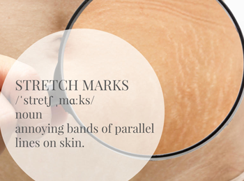 stretch marks treatment in singapore