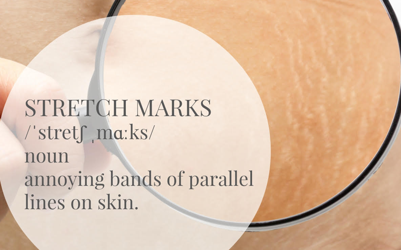 stretch marks treatment in singapore